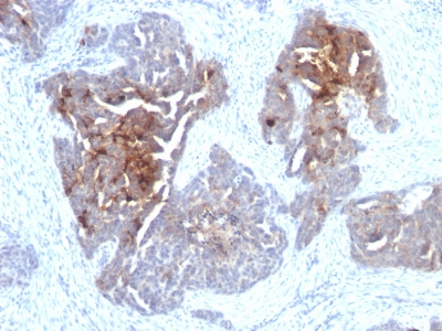 FFPE human ovarian carcinoma sections stained with 100 ul anti-TAG-72 / CA72.4 (clone CA72/733) at 1:300. HIER epitope retrieval prior to staining was performed in 10mM Citrate, pH 6.0.